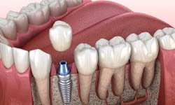 single dental implant in the jawbone