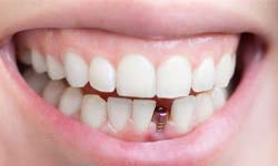 visible dental implant abutment in a smile