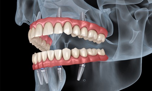 Illustration of All on 4 for top and bottom dental arches