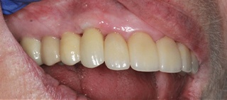 Smile after dental implant tooth replacement