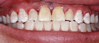 Smile after tooth colored filling restorations