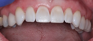 Beautiful smile after cosmetic dental bonding