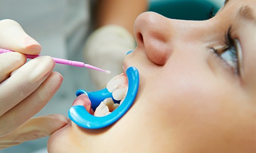Young dental patient receiving fluoride treatment