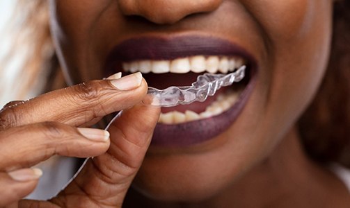 Close up of dental patient using ClearCorrect in Idaho Falls