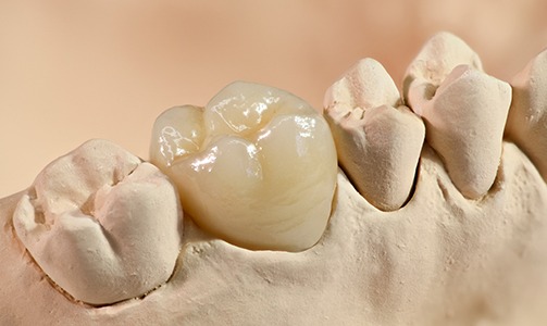 Model of the mouth with dental crown covering one tooth