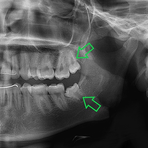 X ray of impacted teeth needing tooth extractions in Idaho Falls