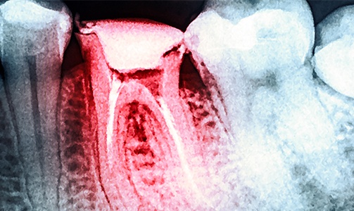 X ray of damaged tooth before extraction