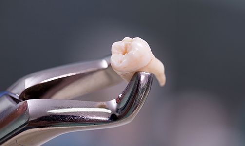 Metal clasp holding extracted tooth