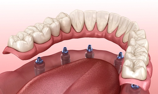 Illustrated implant denture being placed on lower arch