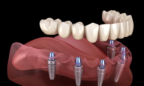 Model of lower implant denture