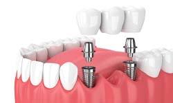 two implants supporting a dental bridge