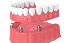 four dental implants supporting a denture