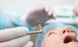 Dentist holding a dental implant with tweezers during surgery