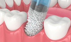 Illustrated bone grafting material being placed into jawbone