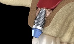 Illustrated dental implant post in upper jaw near sinus