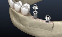 Two dental implant posts being placed into lower jawbone