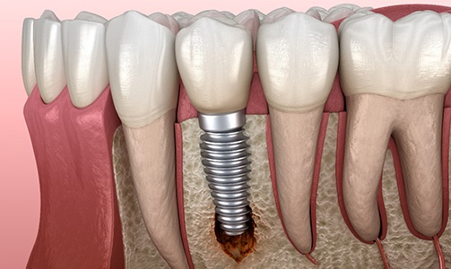 Illustration of jawbone loss causing dental implant failure in Idaho Falls