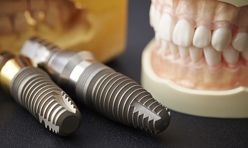 Two dental implant posts and model of the mouth