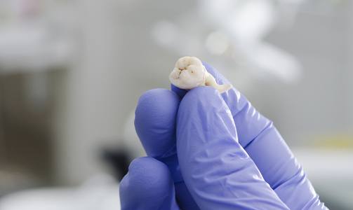 Gloved hand holding an extracted tooth